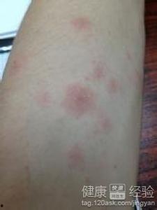 玫瑰糠疹可以吃白瓜吗,玫瑰糠疹患者适宜食用白瓜